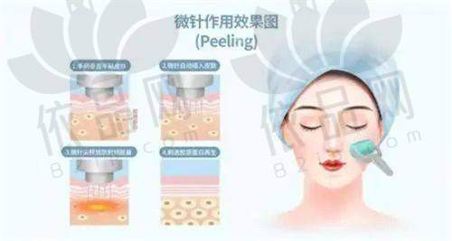杭州星纪医疗美容黄金微针2000元去焕肤抗衰，效果显著优势多！