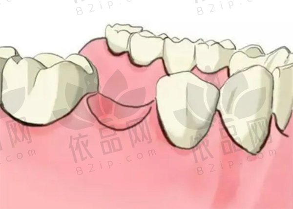 宁波好牙引领口腔儿童龋齿治疗200元起，专业解决儿童龋齿烦恼！