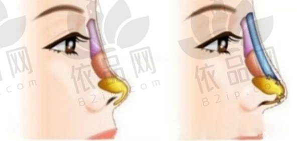 宁波艺星肖庆华鼻修复28000元起，术后鼻型自然，肿胀消退快！