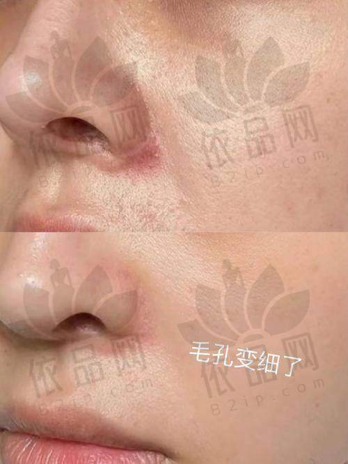黄金微针的疗程与成效