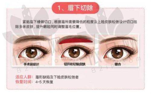 馒头型与蝴蝶型，谁更胜一筹？