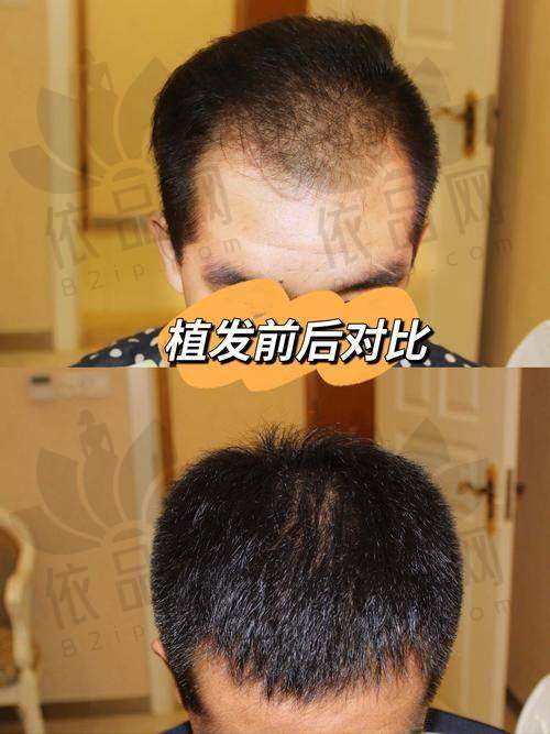 宁波海曙亚植植发陶新进医生口碑评价