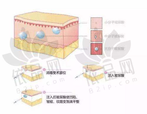 三、合肥维多利亚整形医院美国保妥适2280元起一只，项目优势究竟“优”在何处？