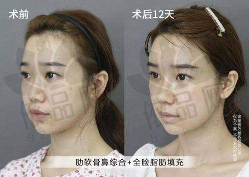 深圳张辉赫本鼻为何预约爆满？自然、实惠、成效显著