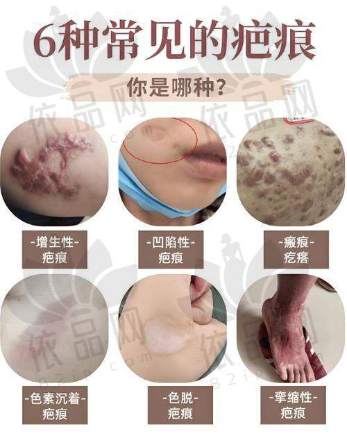 北京京城皮肤医院医生祛疤擅长方向
