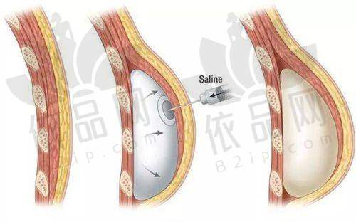 三、大腿吸脂术：实现美腿的有效途径