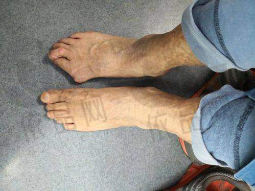 三、双眼皮手术的成效呈现