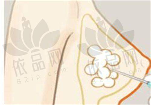 北京磨骨医生名单排名