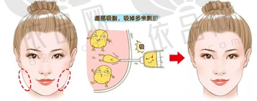 北京面部脂肪填充哪个医生技术好