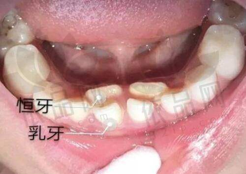 广州地区割双眼皮手术实例