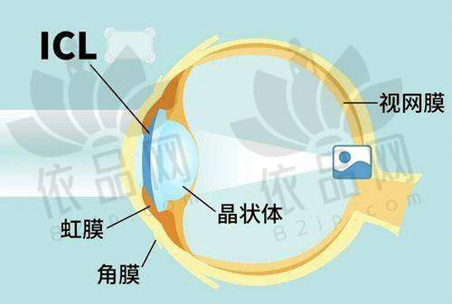 绍兴爱尔眼科白内障手术3255元起，专科团队定制方案，高精准高品质！