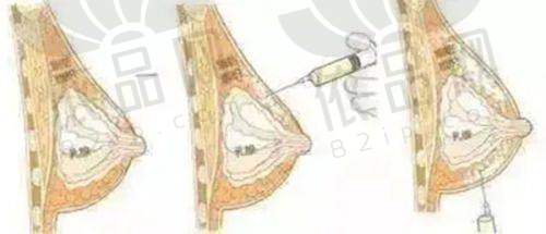 面部吸脂口碑