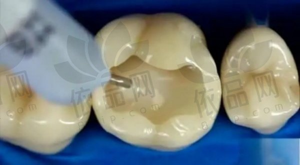 义乌倍雅口腔嵌体补牙1550元起，精准耐用修复，完美贴合恢复咀嚼功能！