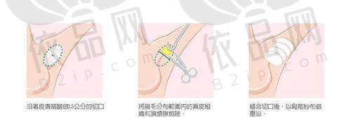 成都八大处唐勇吸脂费用与其他医院对比