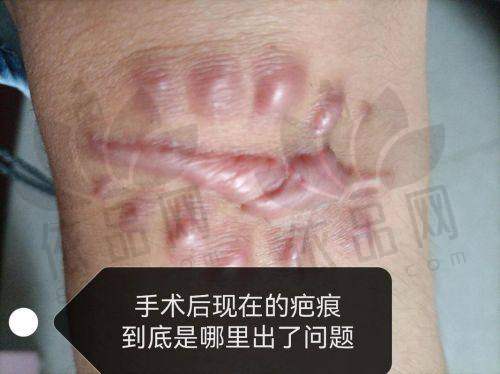 2、成都疤研疤痕医院靠谱吗？