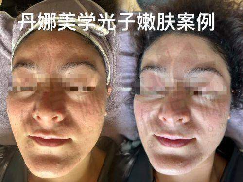 光子嫩肤的未来发展趋势