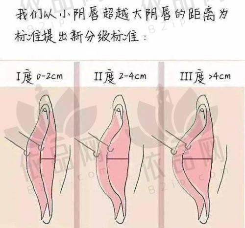 成都棕南医院私密科盆肌底修复单次仅198元起，速来体验！ 
