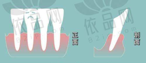 三、微拉美和筋膜悬吊哪个维持时间长？