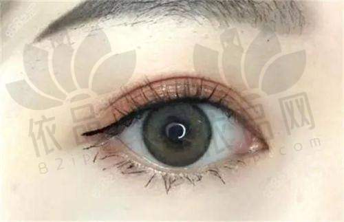 广州艺星曾繁茂双眼皮做得好吗？技术实力强审美自然，擅长眼修复