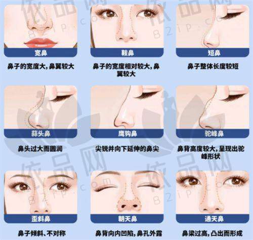 手术精细修复快，注重细节塑造美鼻