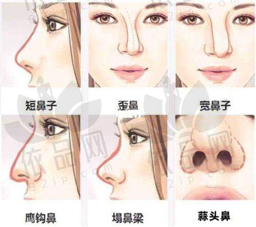 鼻部整形项目价格