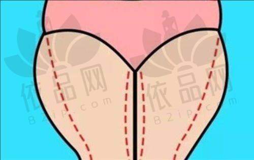 淮北爱美尔大腿吸脂单部位2000元起，AS 维密体雕精准塑形，效果超棒