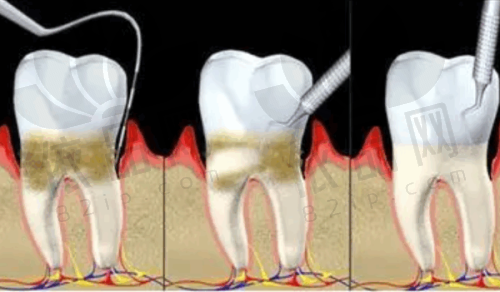 深圳慈恩口腔杨林医生总结