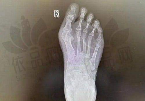 深圳江南春天整形美容医院隆鼻、瘦脸、眼整、面填及种植牙项目价格与效果一览