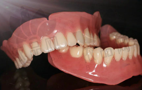 宣城为民口腔杨丽萍医生做根管治疗后牙冠修复1212元起，护牙又美观！