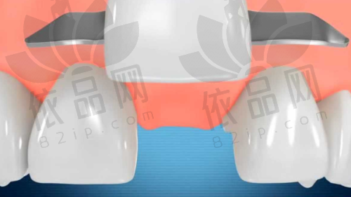 全口义齿的重要性