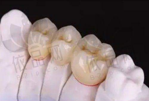 根管治疗后需进行牙冠修复的原因