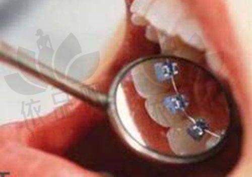 根管治疗后牙冠修复的好处