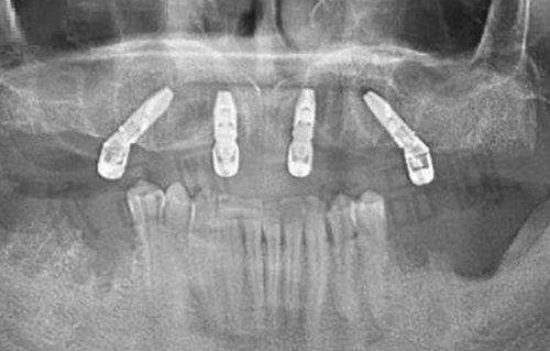 杨丽萍医生——根管治疗后牙冠修复的骨干医生