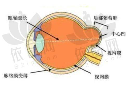 如何选择适合自己的近视手术