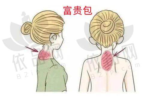 公主馒化针怎么打