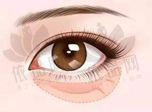 广州瑞美医疗美容门诊部割双眼皮、熊猫针、大拉皮等项目价格合理，最低5000元起