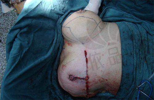 成都渼淳玉颜医疗美容耳部整形价格表