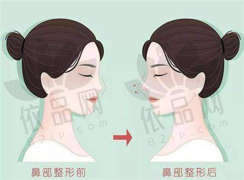 二、上海虹桥医院拇外翻微创手术的优势:创伤小、复发率低