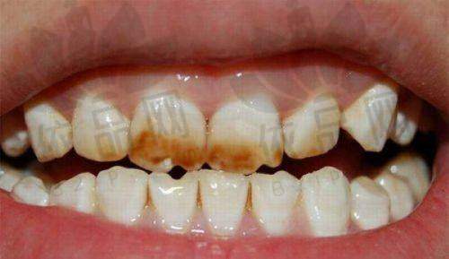 福州牙丽爱口腔树脂补牙200元起/颗，进口材料美观耐用，轻松修复牙齿缺损