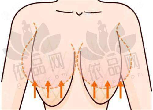 双眼皮项目特色