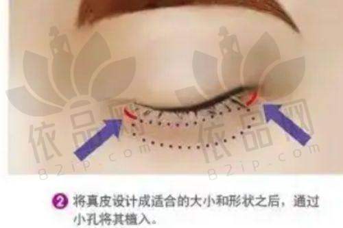 选对玻尿酸特别关键