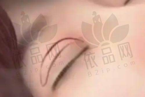 四、面部轮廓整形