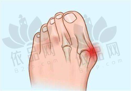 垂直切口术乳房提升术