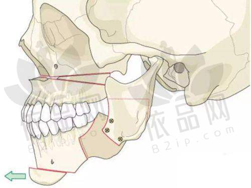 重庆肖林正颌手术98000元起,技术优,多方式预约早规划