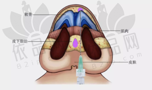 五、珠海中大五院隆胸实例分享