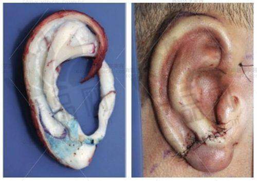 余文林不是网红医生,耳再造唇裂修复实力强,可在线一键预约