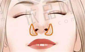 查授权辨别傲诺拉假体真假