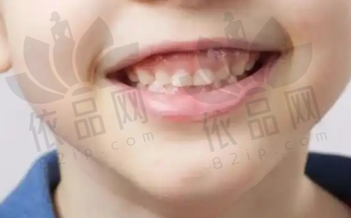 日常清洁如何去除黑色牙菌斑?