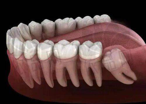 全瓷牙的适用情况
