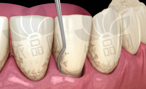 爱尔创和瓷倍健全瓷牙的特点